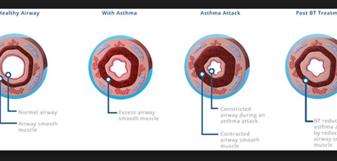 Here is the podcast of my chat with Ed Phillips about asthma