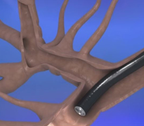 Pulmonary-Cryobiopsy