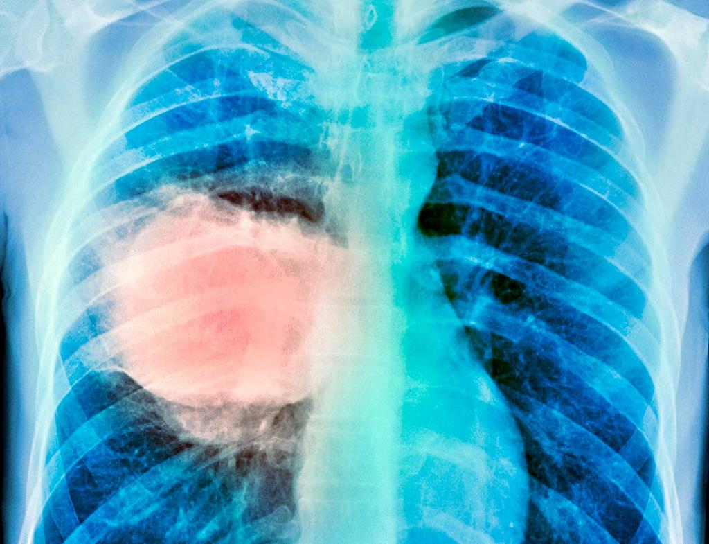 Resp-Conditions-lung-cancer