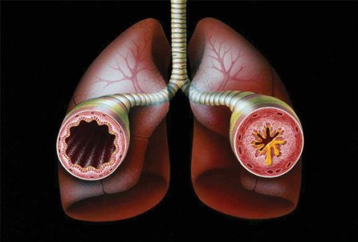 resp-conditions-Asthma
