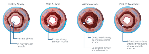 Bronchial Thermoplasty (BT) demonstrates long term safety and efficacy to 10 years